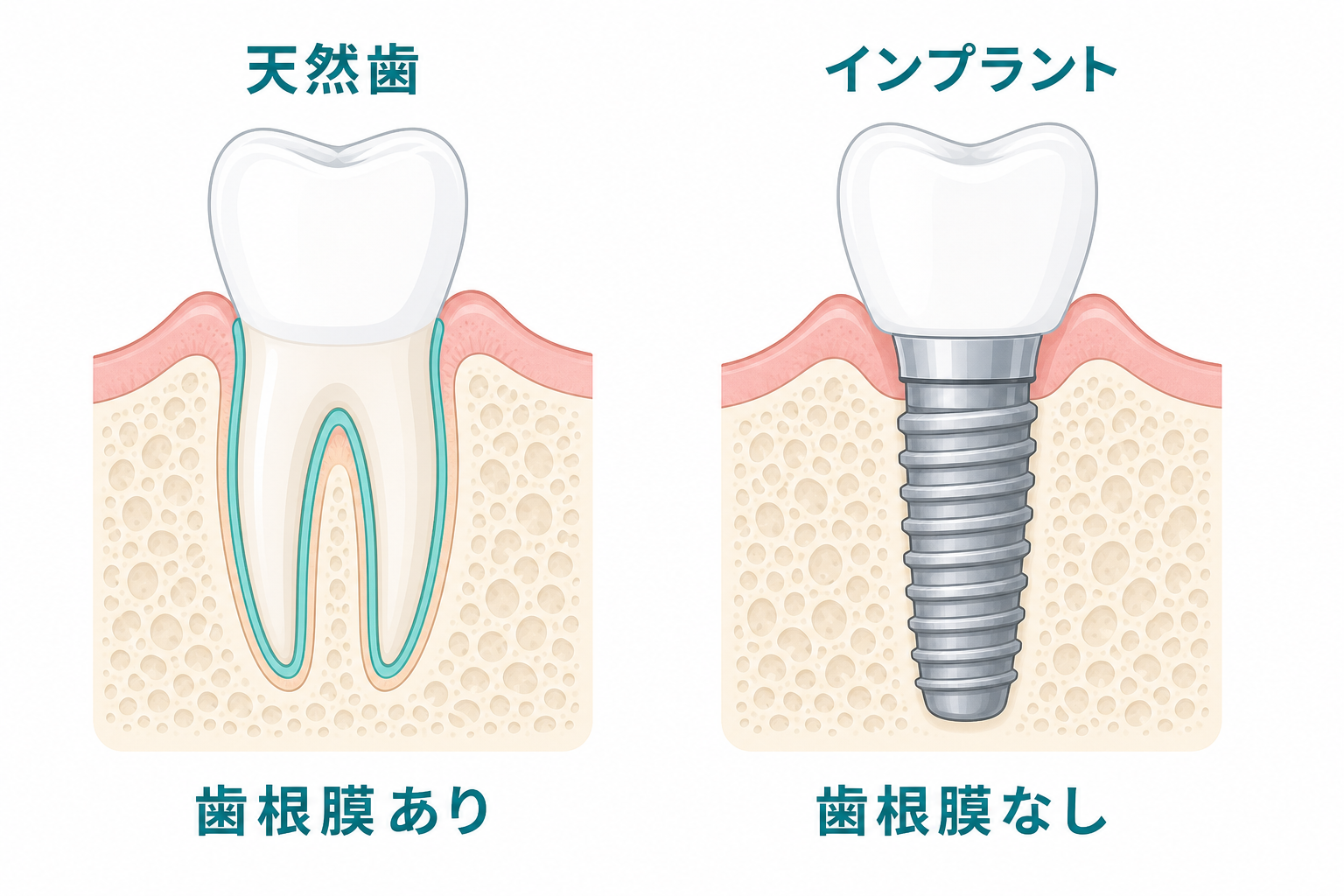 天然歯とインプラントの構造の違い(歯根膜の有無)を示す模式図